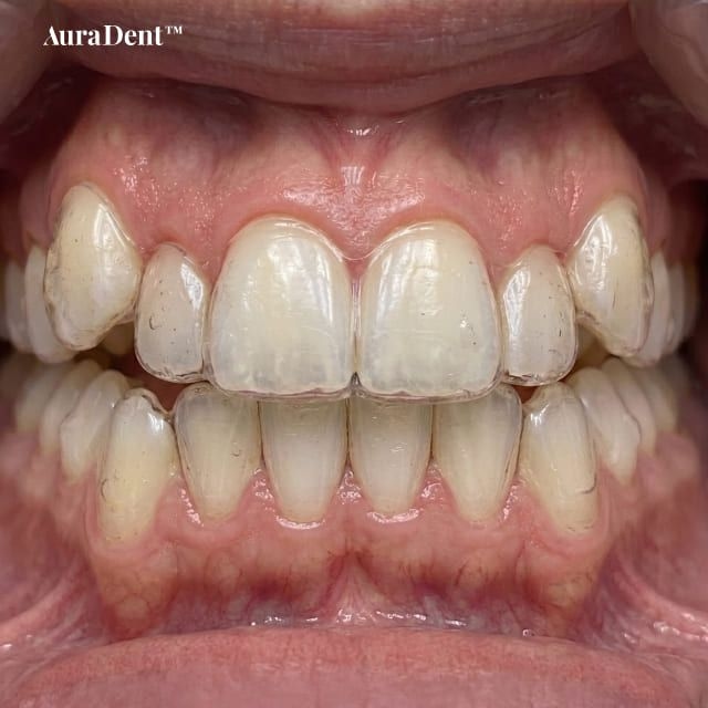 Närbild på en person som bär genomskinliga Invisalign-skenor med små synliga fästen på tänderna, med en tandläkarstol och en digital behandlingsplan på en skärm i bakgrunden.