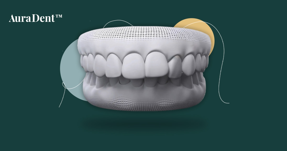How Long Do You Wear Braces for Overbite