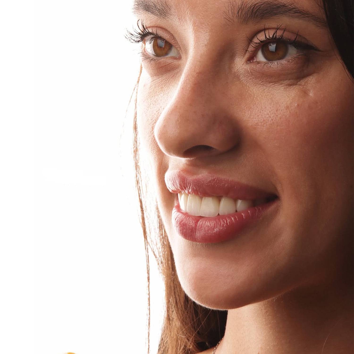 veneers