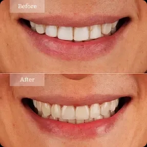 veneers before and after