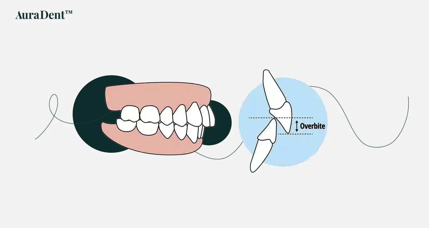 what is an overbite
